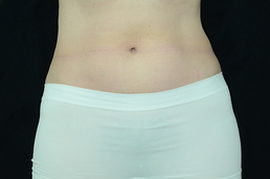 womans belly after blue fat freeze treatment