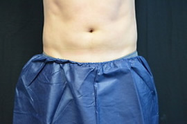 mans belly after using blue fat freeze treatment