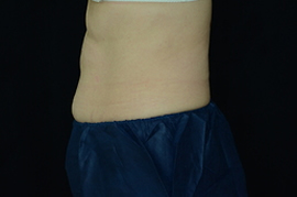 side view of man's belly with blue fat freeze technology
