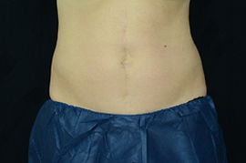 mans belly after using blue fat freeze system