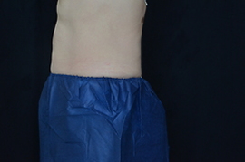side view of man's belly with blue fat freezing procedure