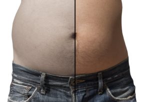 before and after man love handles fat freeze treatment weightloss