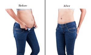 before and after fat freeze procedure