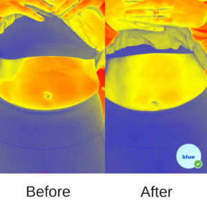 Thermal image showing the cooling effect of blue fat freezing system