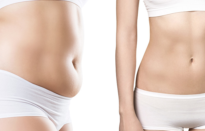 Fat Freezing: Does it Work?